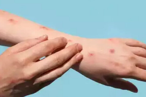 Monkeypox Case