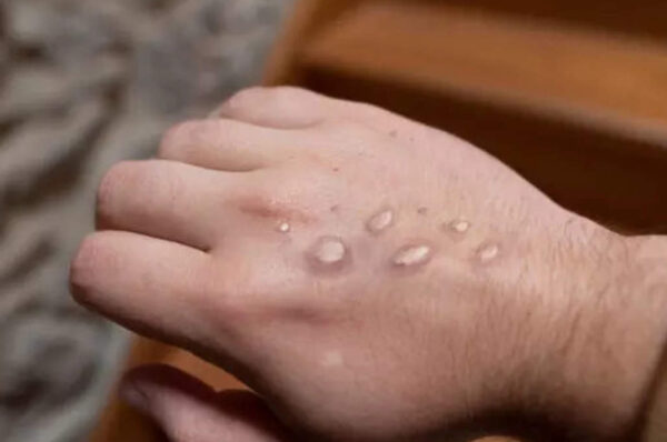 Monkey Pox cases in Islamabad