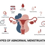 8 Types of Abnormal Menstruation